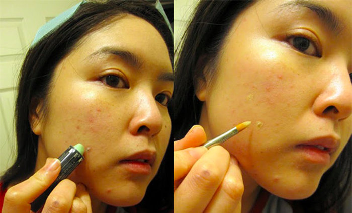 Covering blemishes and acne using concealer